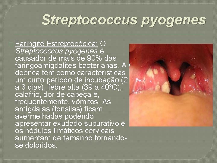 Streptococcus pyogenes � Faringite Estreptocócica: O Streptococcus pyogenes é causador de mais de 90%