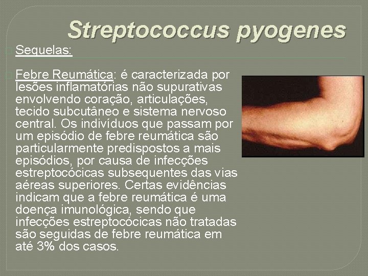 Streptococcus pyogenes � Sequelas: � Febre Reumática: é caracterizada por lesões inflamatórias não supurativas