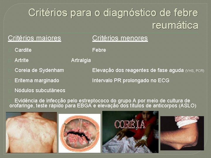 Critérios para o diagnóstico de febre reumática Critérios maiores Critérios menores � Cardite Febre