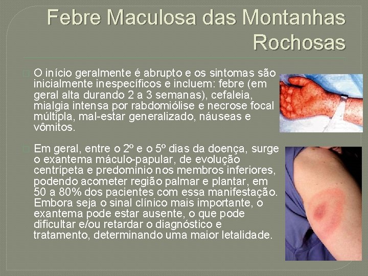 Febre Maculosa das Montanhas Rochosas � O início geralmente é abrupto e os sintomas