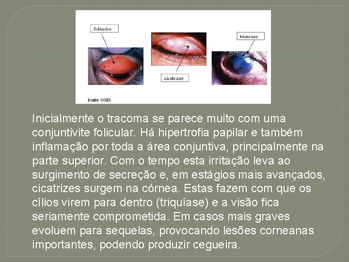 � Inicialmente o tracoma se parece muito com uma conjuntivite folicular. Há hipertrofia papilar