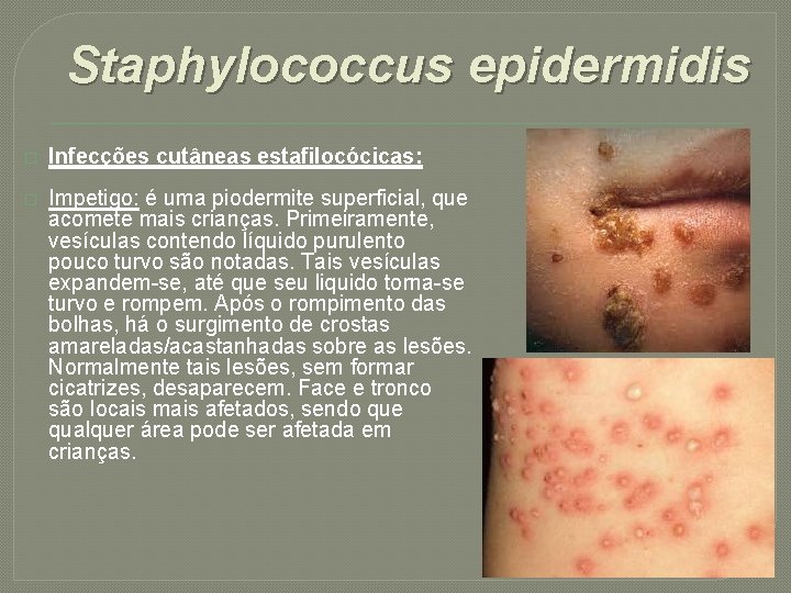 Staphylococcus epidermidis � Infecções cutâneas estafilocócicas: � Impetigo: é uma piodermite superficial, que acomete