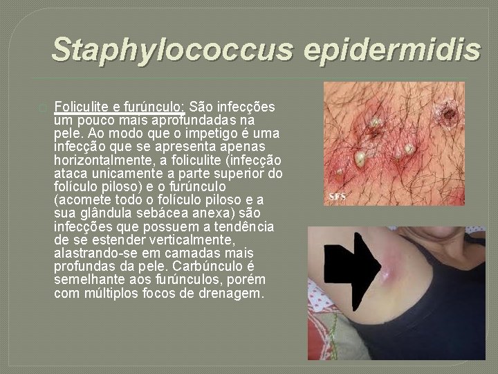 Staphylococcus epidermidis � Foliculite e furúnculo: São infecções um pouco mais aprofundadas na pele.