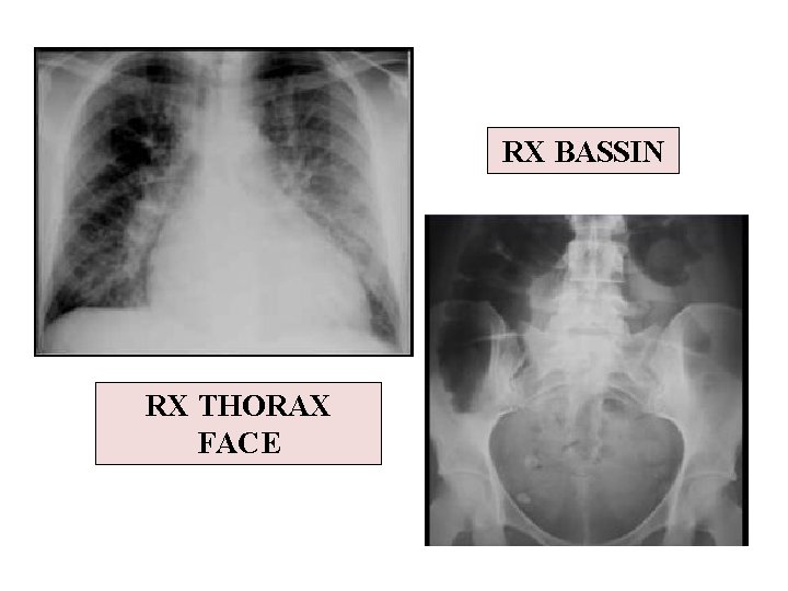 RX BASSIN RX THORAX FACE 