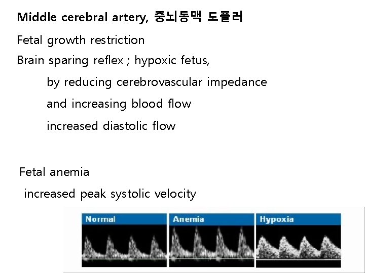 Middle cerebral artery, 중뇌동맥 도플러 Fetal growth restriction Brain sparing reflex ; hypoxic fetus,