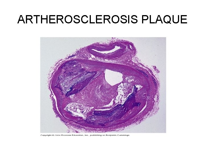 ARTHEROSCLEROSIS PLAQUE 