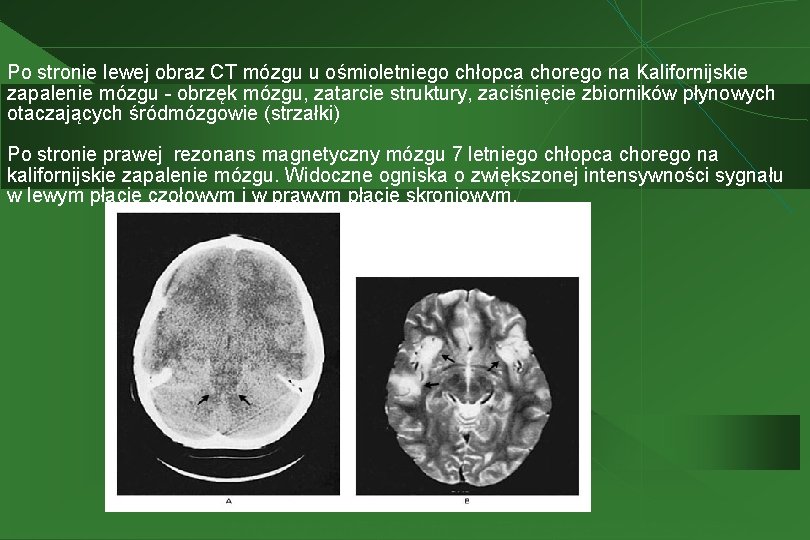 Po stronie lewej obraz CT mózgu u ośmioletniego chłopca chorego na Kalifornijskie zapalenie mózgu