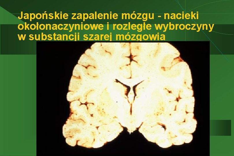 Japońskie zapalenie mózgu - nacieki okołonaczyniowe i rozległe wybroczyny w substancji szarej mózgowia 