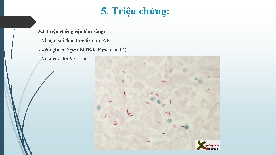 5. Triệu chứng: 5. 2 Triệu chứng cận lâm sàng: - Nhuộm soi đờm