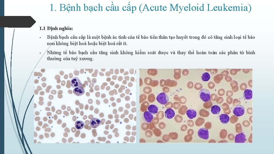 1. Bệnh bạch cầu cấp (Acute Myeloid Leukemia) 1. 1 Định nghĩa: - Bệnh