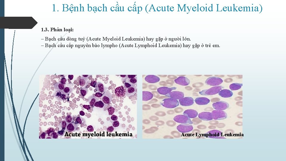 1. Bệnh bạch cầu cấp (Acute Myeloid Leukemia) 1. 3. Phân loại: ‒ Bạch