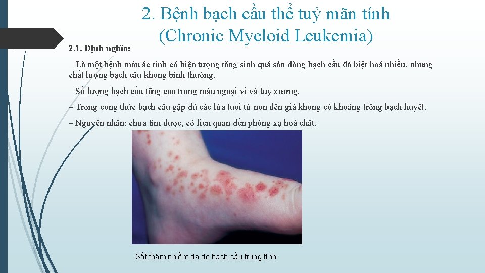 2. 1. Định nghĩa: 2. Bệnh bạch cầu thể tuỷ mãn tính (Chronic Myeloid