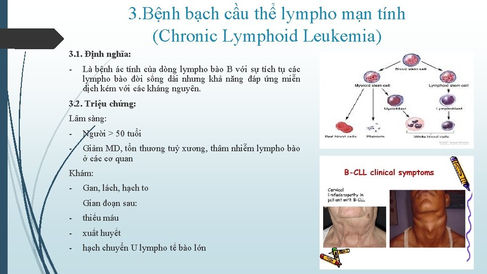 3. Bệnh bạch cầu thể lympho mạn tính (Chronic Lymphoid Leukemia) 3. 1. Định