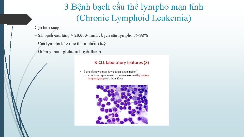 3. Bệnh bạch cầu thể lympho mạn tính (Chronic Lymphoid Leukemia) Cận lâm sàng: