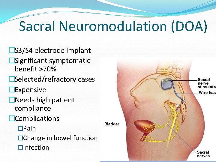 Sacral Neuromodulation (DOA) �S 3/S 4 electrode implant �Significant symptomatic benefit >70% �Selected/refractory cases