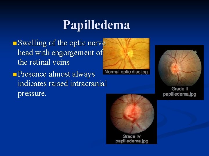 Papilledema n Swelling of the optic nerve head with engorgement of the retinal veins