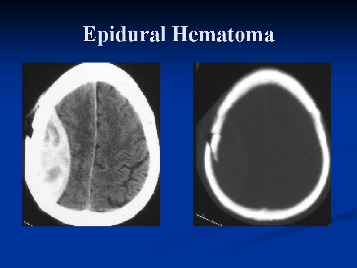 Epidural Hematoma 