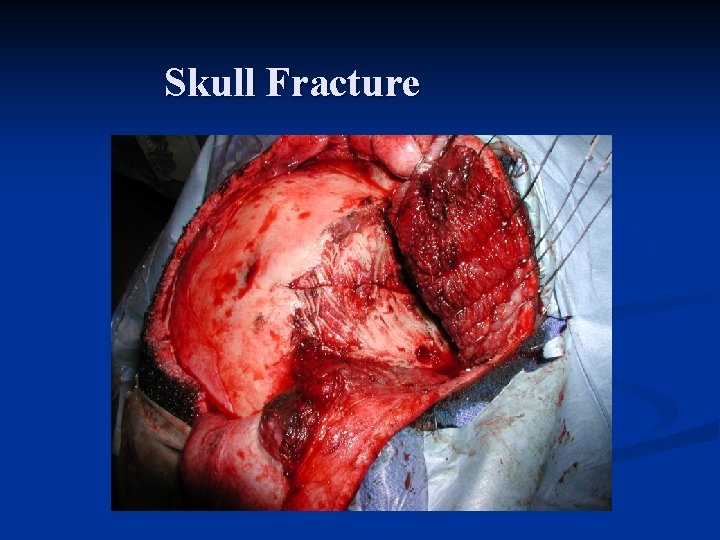 Skull Fracture 