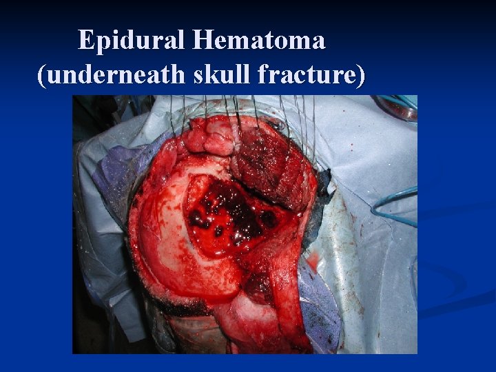 Epidural Hematoma (underneath skull fracture) 
