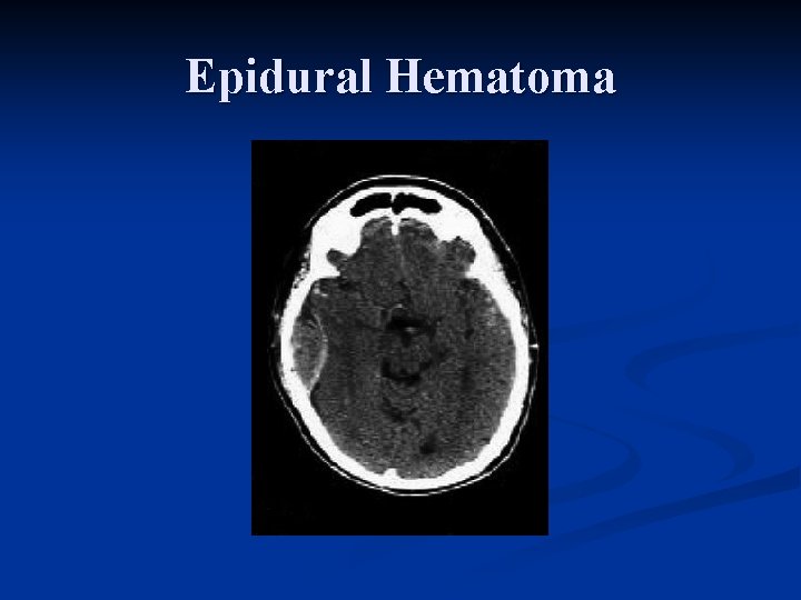 Epidural Hematoma 