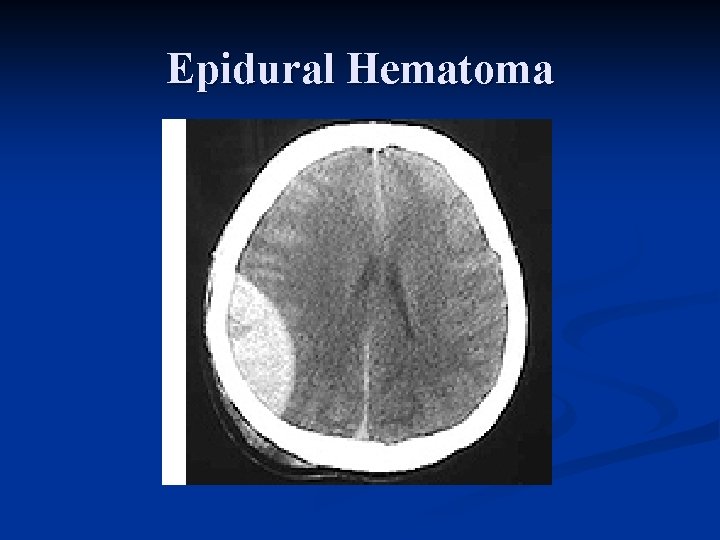 Epidural Hematoma 