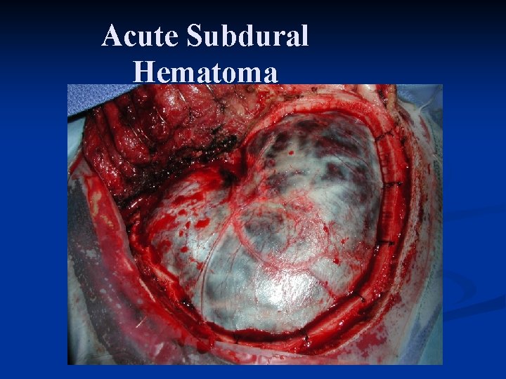 Acute Subdural Hematoma 