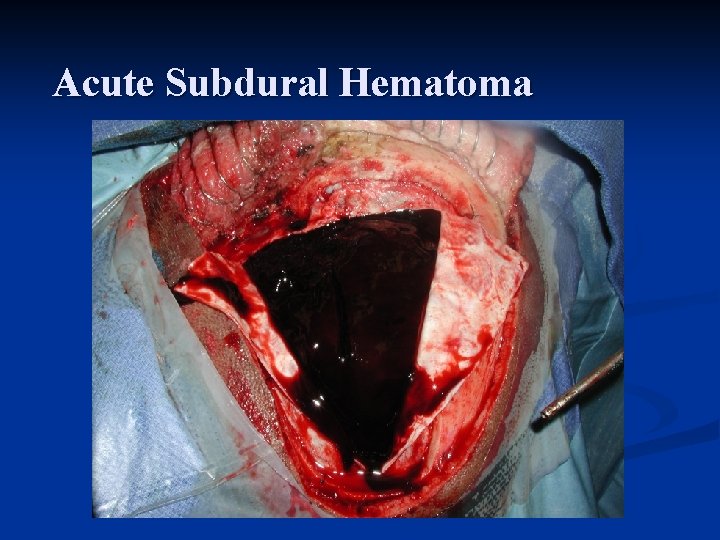 Acute Subdural Hematoma 