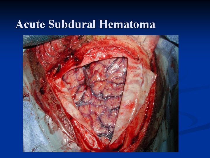 Acute Subdural Hematoma 