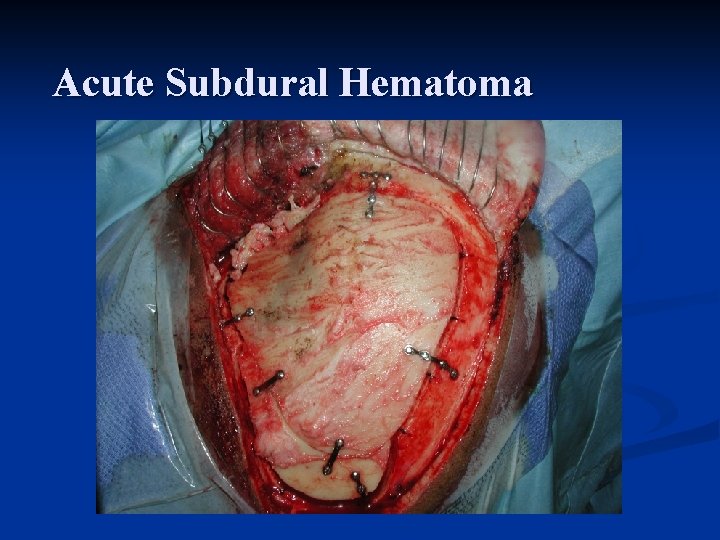 Acute Subdural Hematoma 