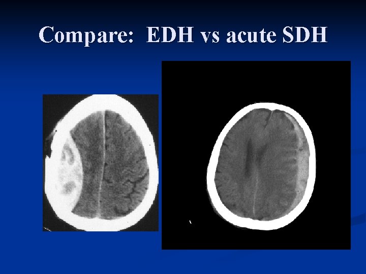 Compare: EDH vs acute SDH 