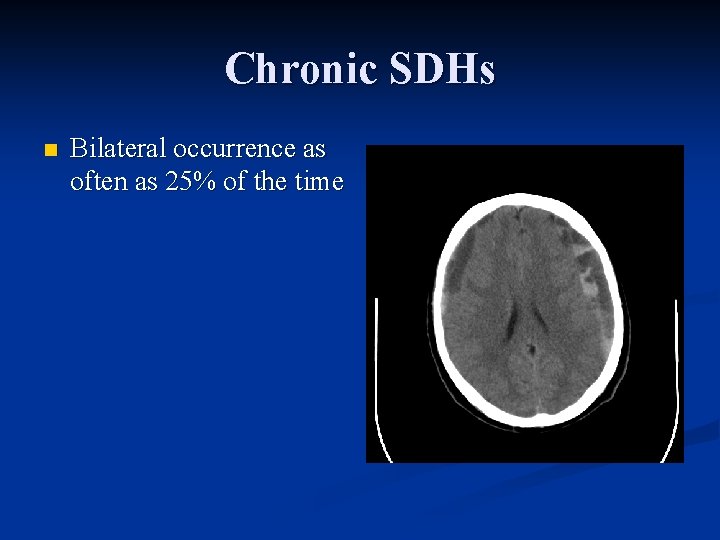 Chronic SDHs n Bilateral occurrence as often as 25% of the time 