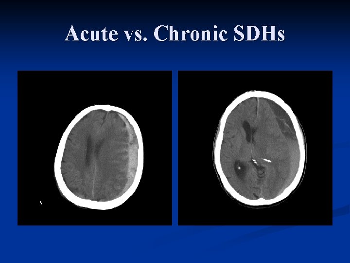 Acute vs. Chronic SDHs 