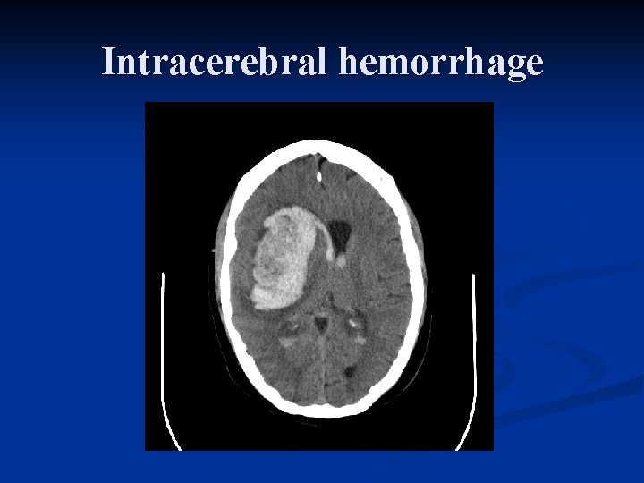 Intracerebral hemorrhage 