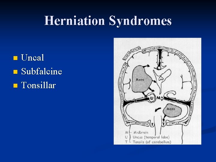 Herniation Syndromes Uncal n Subfalcine n Tonsillar n 