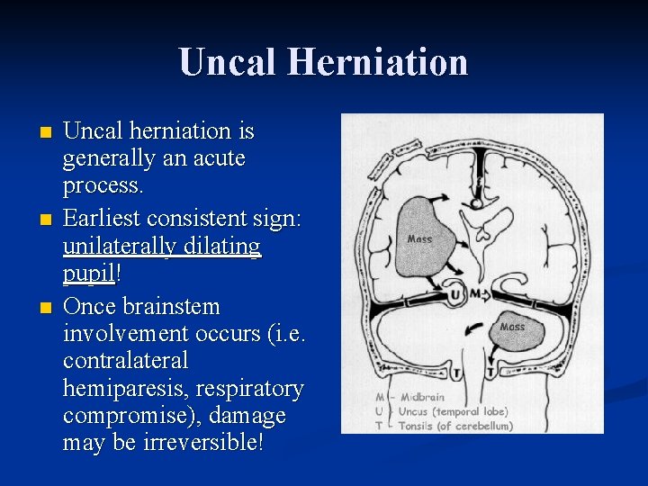 Uncal Herniation n Uncal herniation is generally an acute process. Earliest consistent sign: unilaterally