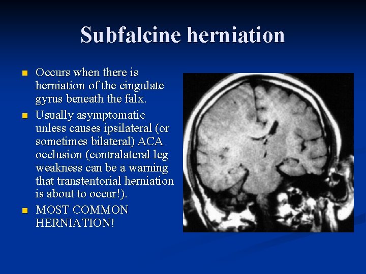 Subfalcine herniation n Occurs when there is herniation of the cingulate gyrus beneath the