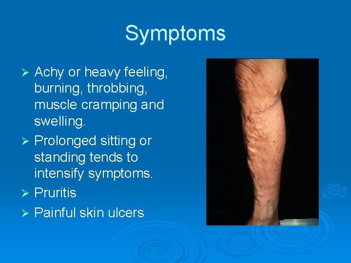 Symptoms Achy or heavy feeling, burning, throbbing, muscle cramping and swelling. Ø Prolonged sitting