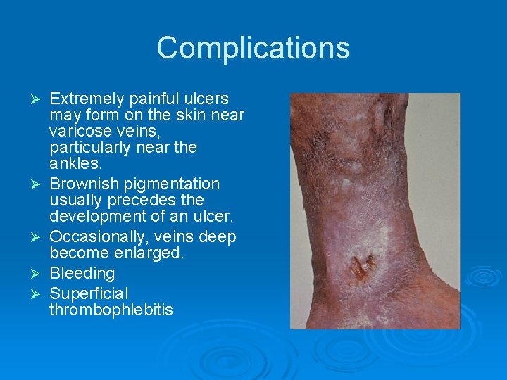 Complications Ø Ø Ø Extremely painful ulcers may form on the skin near varicose