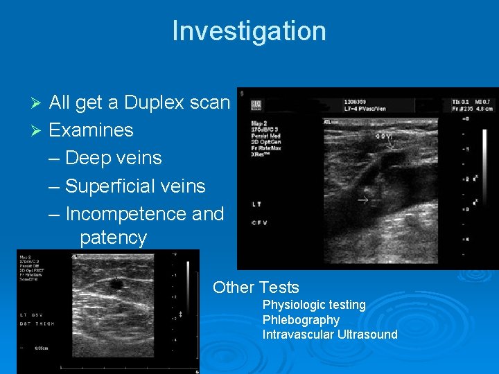 Investigation All get a Duplex scan Ø Examines – Deep veins – Superficial veins
