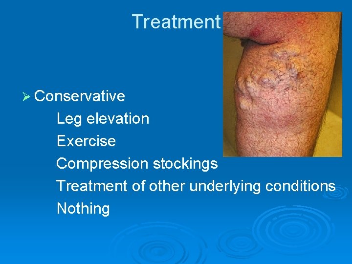 Treatment Ø Conservative Leg elevation Exercise Compression stockings Treatment of other underlying conditions Nothing