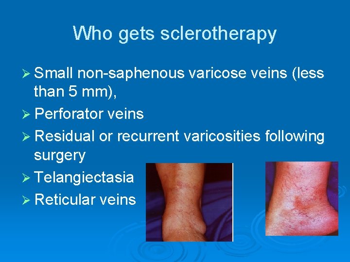 Who gets sclerotherapy Ø Small non-saphenous varicose veins (less than 5 mm), Ø Perforator