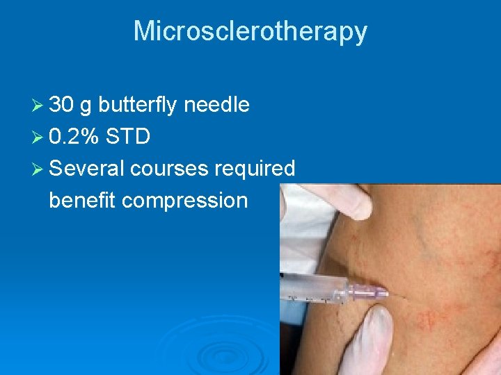 Microsclerotherapy Ø 30 g butterfly needle Ø 0. 2% STD Ø Several courses required