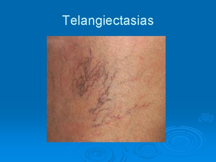 Telangiectasias 