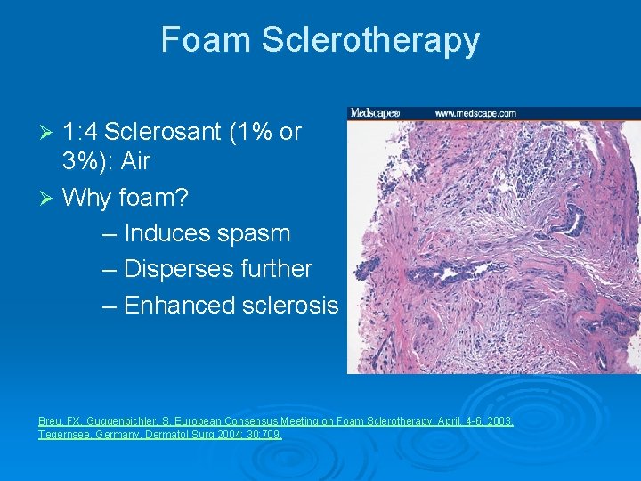 Foam Sclerotherapy 1: 4 Sclerosant (1% or 3%): Air Ø Why foam? – Induces