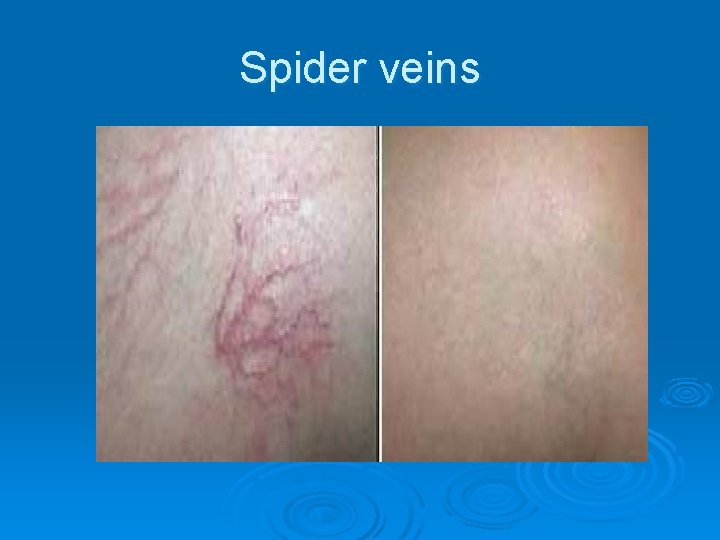 Spider veins 