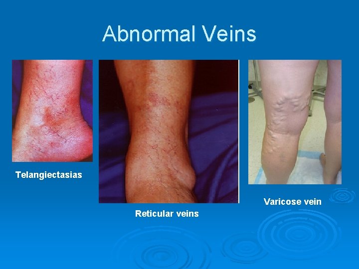 Abnormal Veins Telangiectasias Varicose vein Reticular veins 