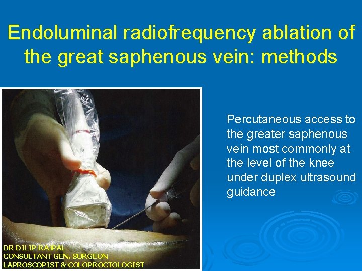 Endoluminal radiofrequency ablation of the great saphenous vein: methods Percutaneous access to the greater