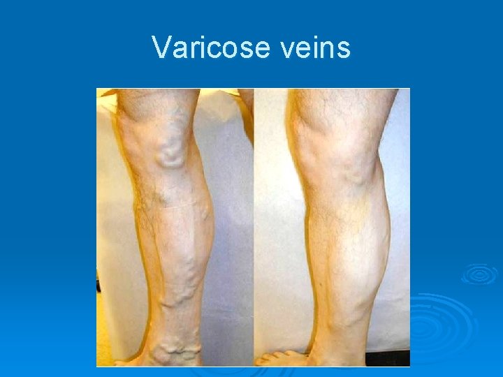 Varicose veins 