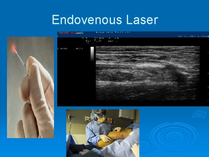 Endovenous Laser 