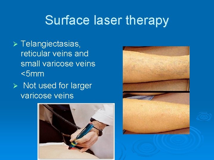 Surface laser therapy Telangiectasias, reticular veins and small varicose veins <5 mm Ø Not